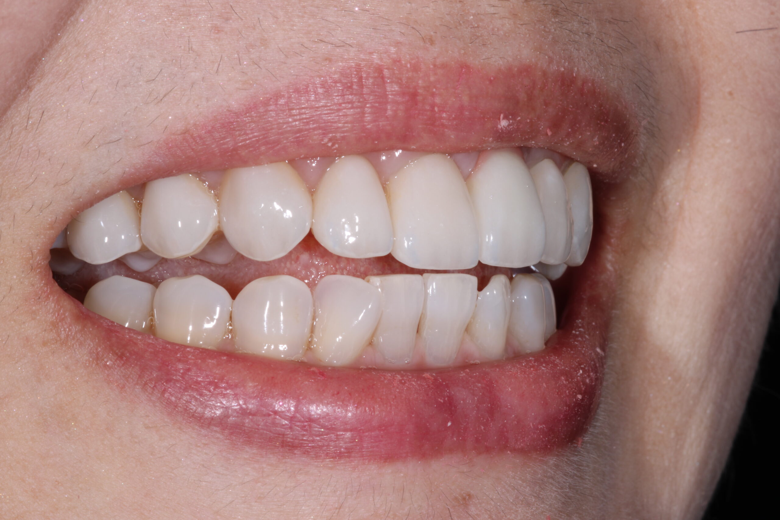 Veneers Say After