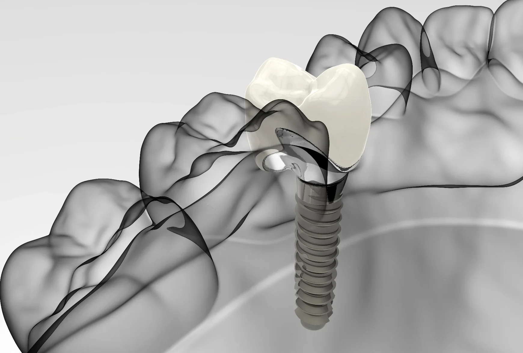 how-dental-implant-works.png