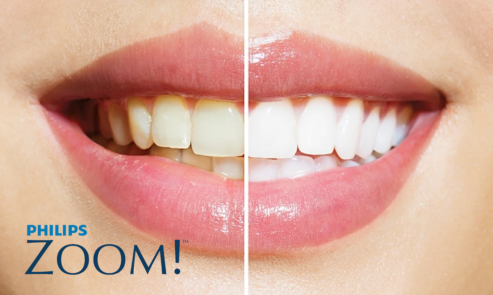teeth-whitening-dazzling-results.png